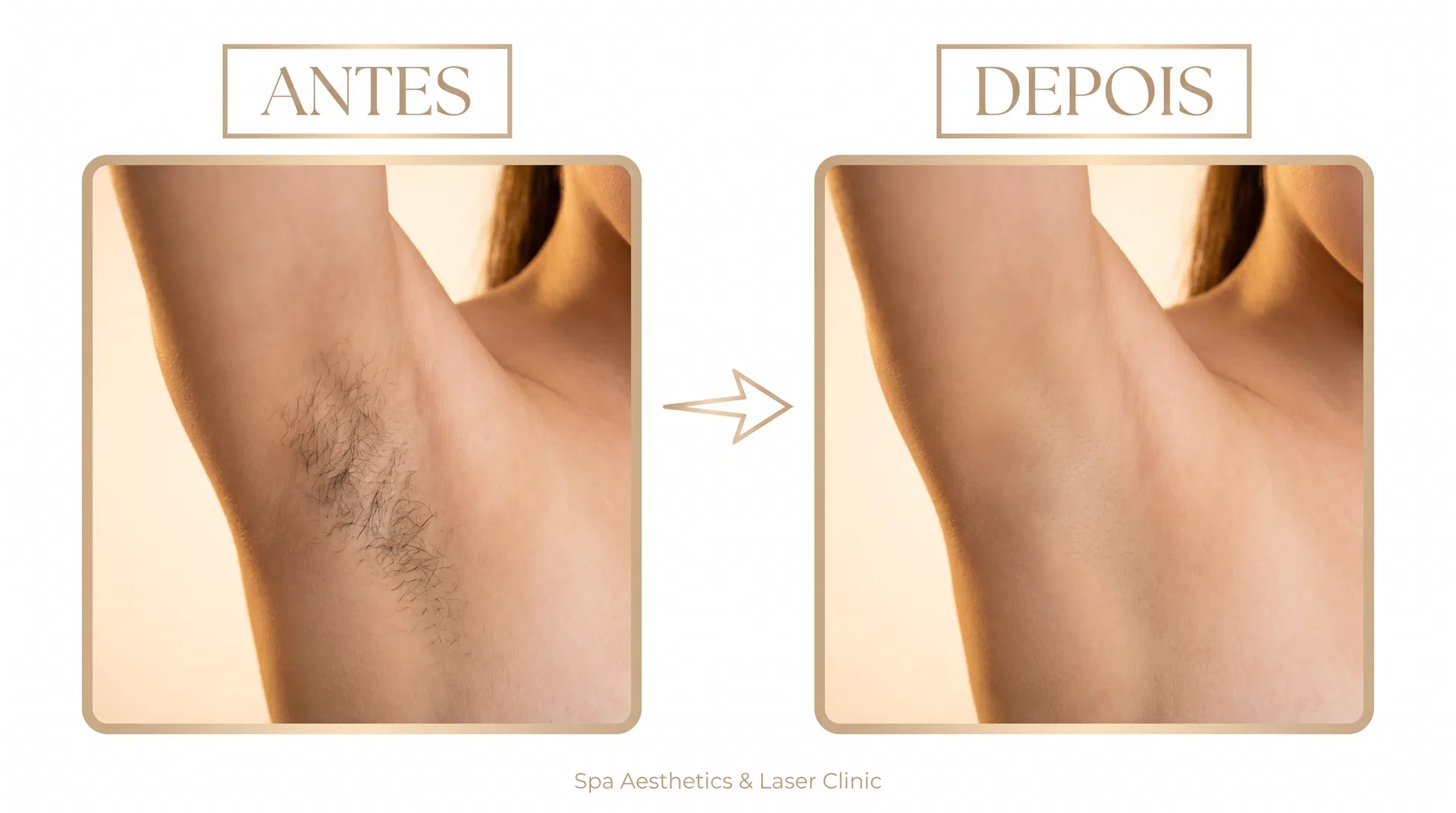 Antes e depois depilação a laser na axila